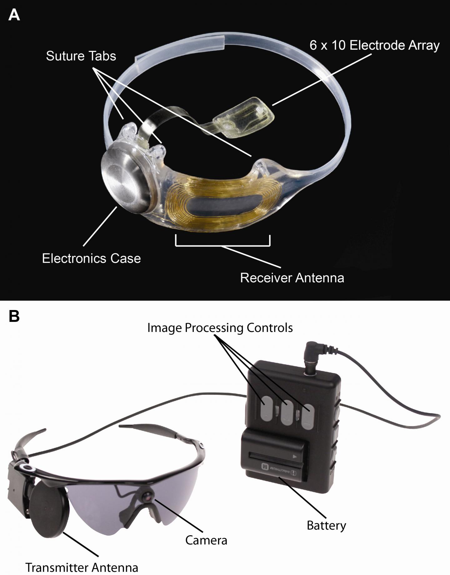  Caption: Figure A, The implanted portions of the Argus II System. Figure B, The external components of the Argus II System. Images in real time are captured by camera mounted on the glasses. The video processing unit down-samples and processes the image, converting it to stimulation patterns. Data and power are sent via radiofrequency link form the transmitter antenna on the glasses to the receiver antenna around the eye. A removable, rechargeable battery powers the system. Credit: Photo courtesy of Second Sight Medical Products, Inc.